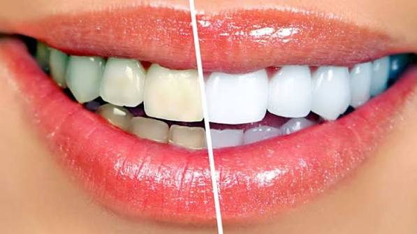 Teeth Whitening Meerut